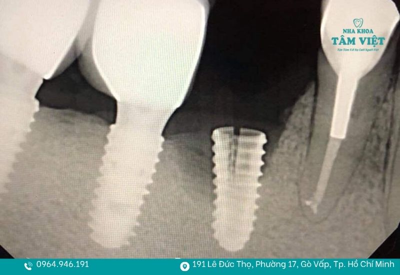 Mô phỏng trụ implant bị gãy