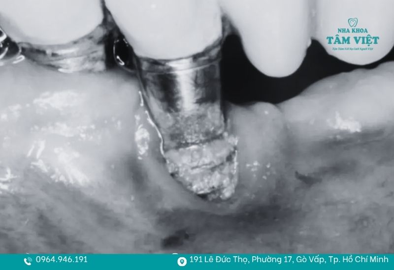 Mô phỏng vít bị gãy