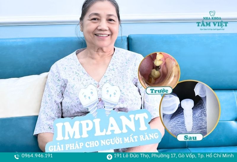 Trồng răng implant an toàn