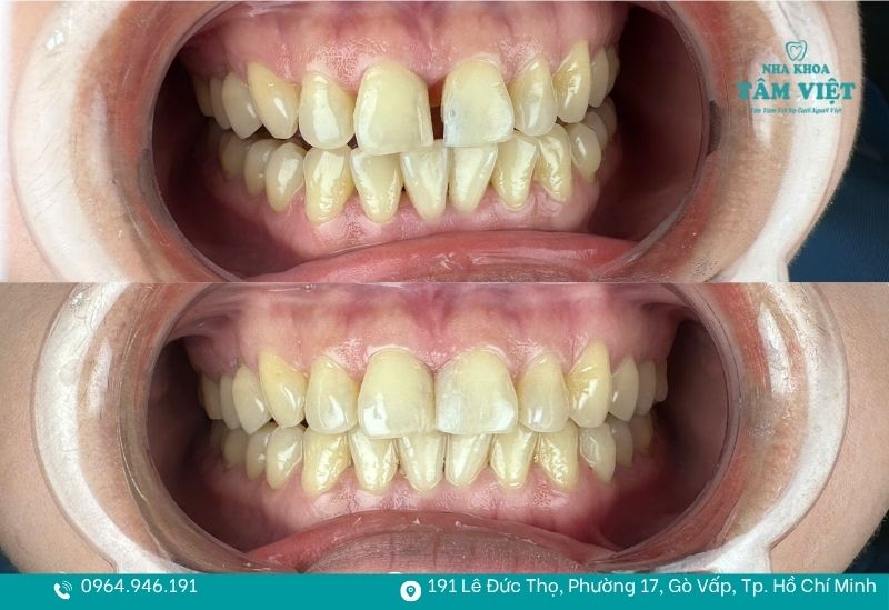 Trám răng là giải pháp phục hồi nhanh chóng