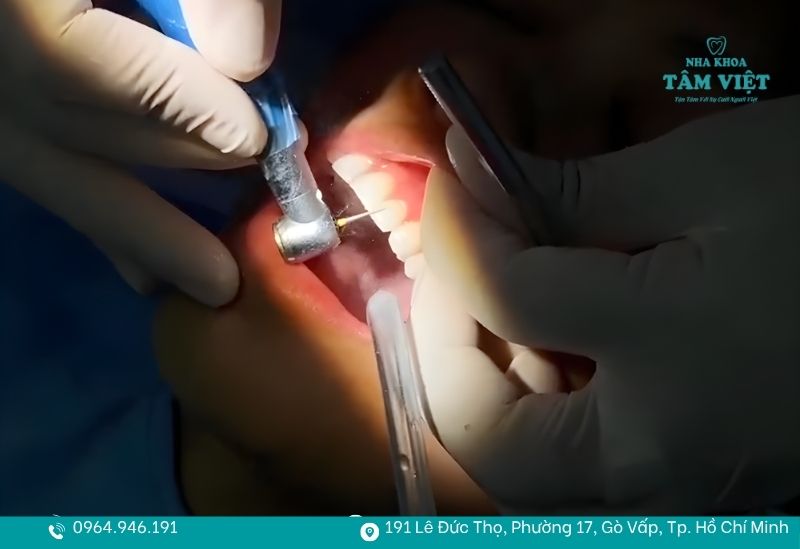 Thực hiện trám bằng vật liệu an toàn