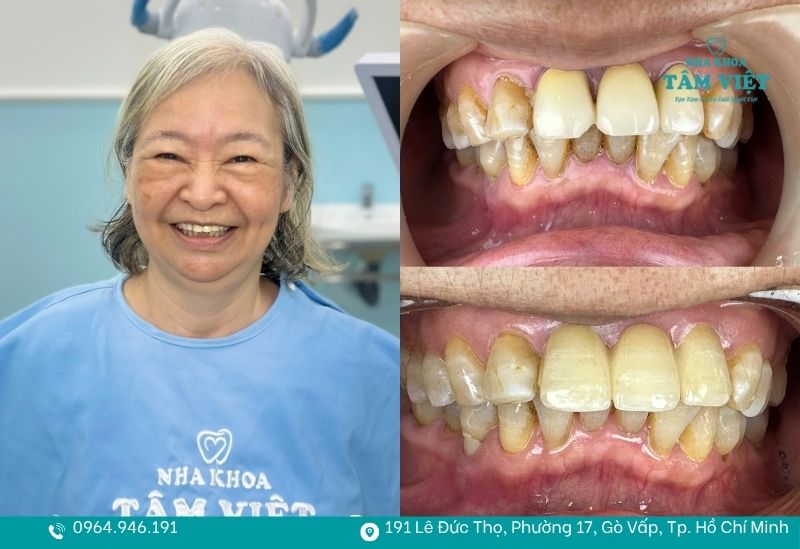 Trám răng tại Nha khoa Tâm Việt