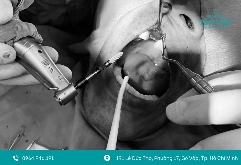 Cách khắc phục khi nhiễm trùng implant