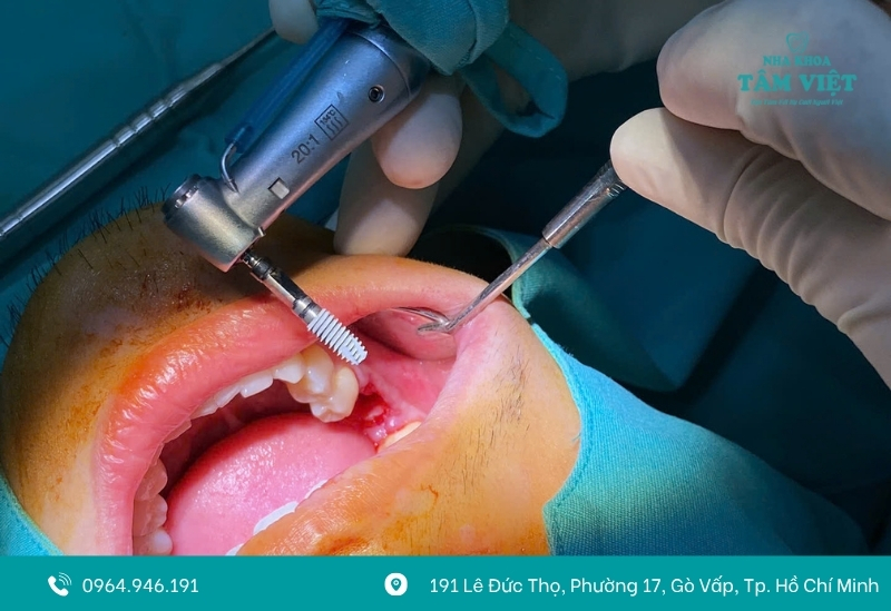 Trồng răng implant bị nhiễm trùng có nguy hiểm không?