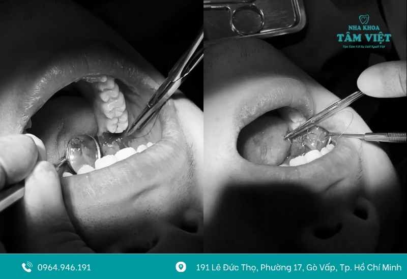 Trồng răng implant bị nhiễm trùng là gì?