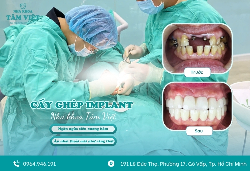 Địa chỉ trồng răng implant an toàn, uy tín tại TPHCM