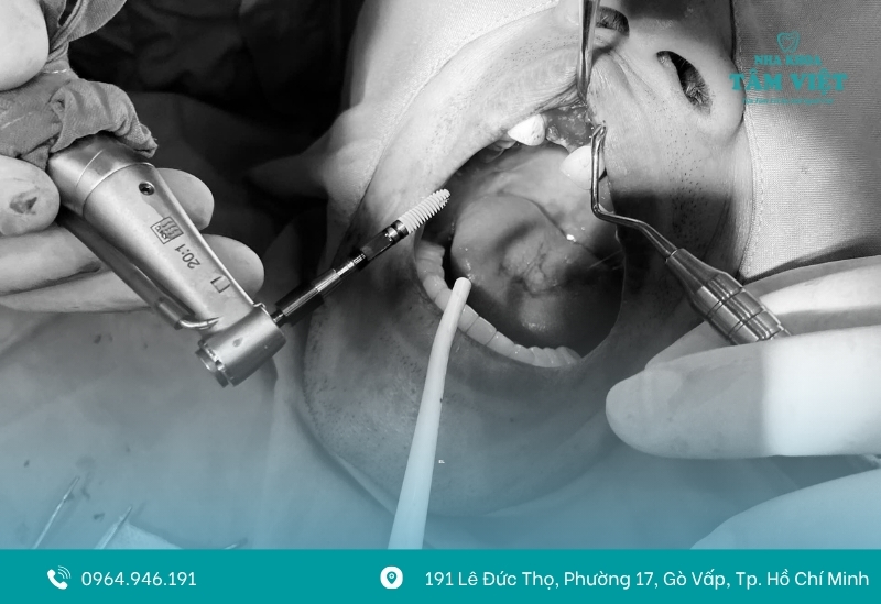 Trụ implant Hàn Quốc cân bằng giữa chất lượng và chi phí