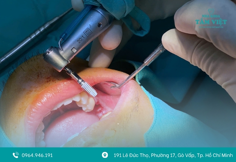 Tiêu chí đánh giá trụ implant loại nào tốt