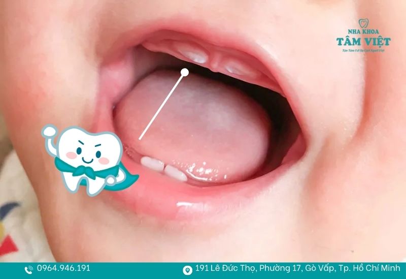 1 chiếc răng sữa mọc trong bao lâu và cách chăm sóc đúng 2 1 chiếc răng sữa mọc trong bao lâu?