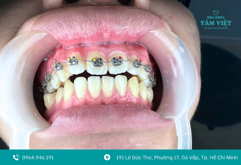 Bảng giá niềng răng rẻ nhất mới nhất hiện nay 3 Các yếu tố quyết định giá niềng răng