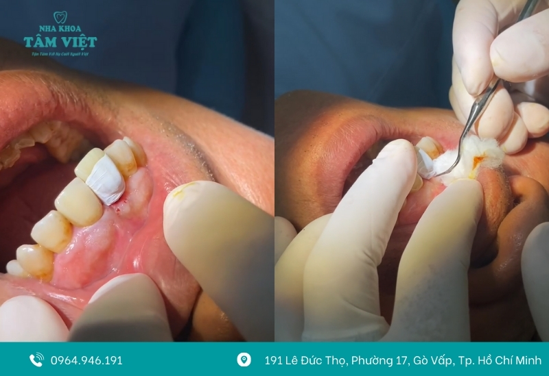 Bọc răng sứ 1 chiếc được không?