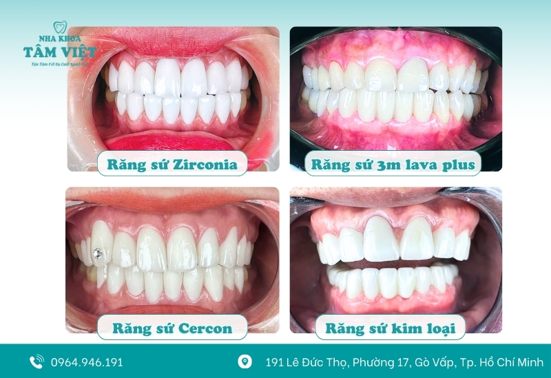 Loại răng sứ sẽ ảnh hưởng trực tiếp đến chi phí bọc răng sứ bao nhiêu