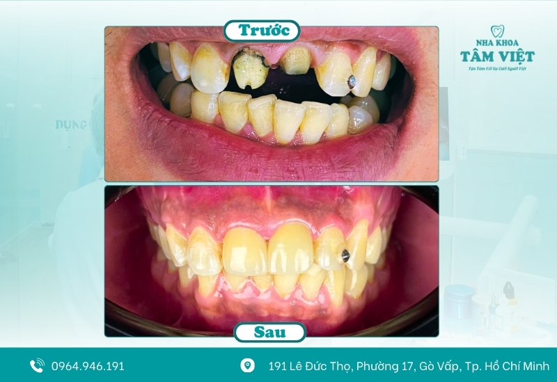 Bọc răng sứ 2 răng cửa là gì?