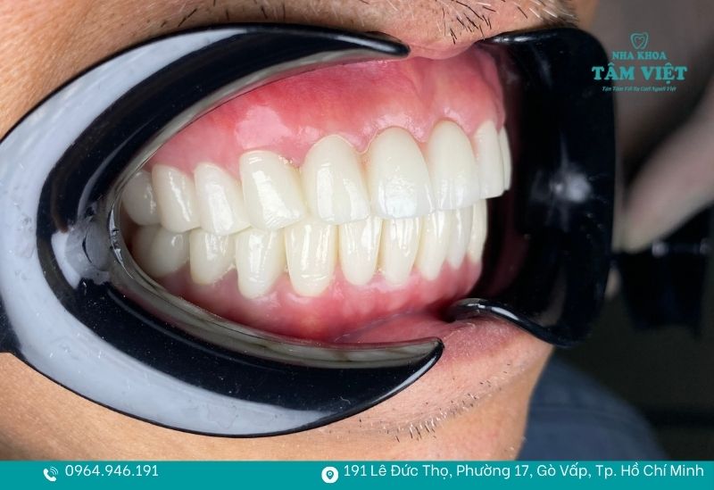 Cách chăm sóc răng sứ sau khi bọc để sử dụng lâu dài, bền đẹp 2 Chăm sóc răng sứ đúng cách giúp kéo dài tuổi thọ