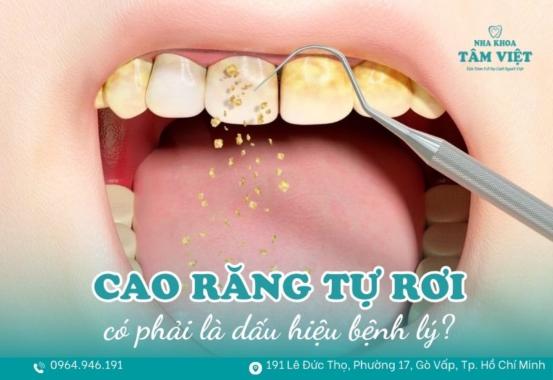 cao răng tự rơi ra