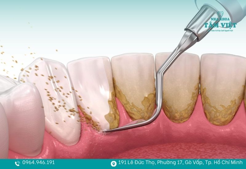 Cao răng bám cực kỳ chắc vào bề mặt men răng