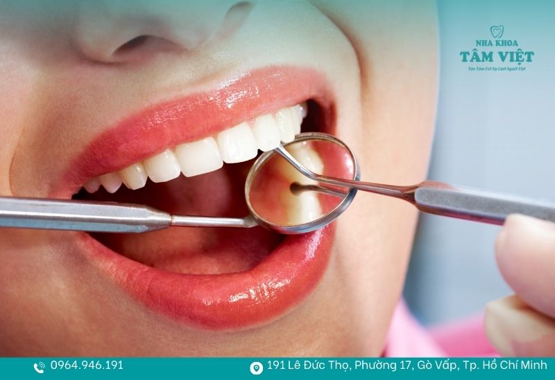 Lấy cao răng để có nụ cười khoẻ đẹp