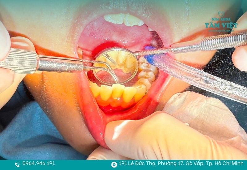 Cao răng tự rơi ra là một dấu hiệu xấu