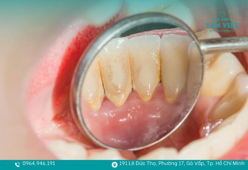 Không được tự cạy cao răng tại nhà