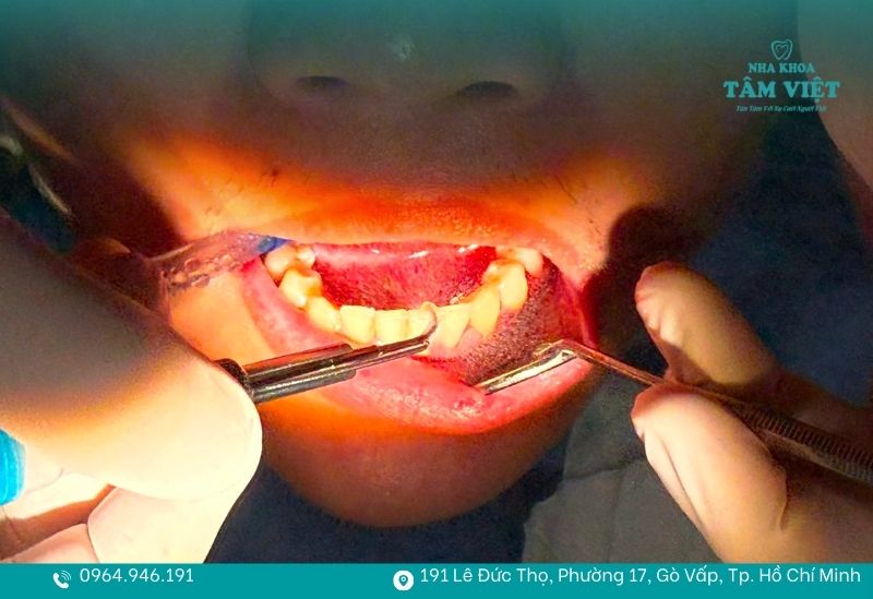 Lấy cao răng tại Nha khoa Tâm Việt