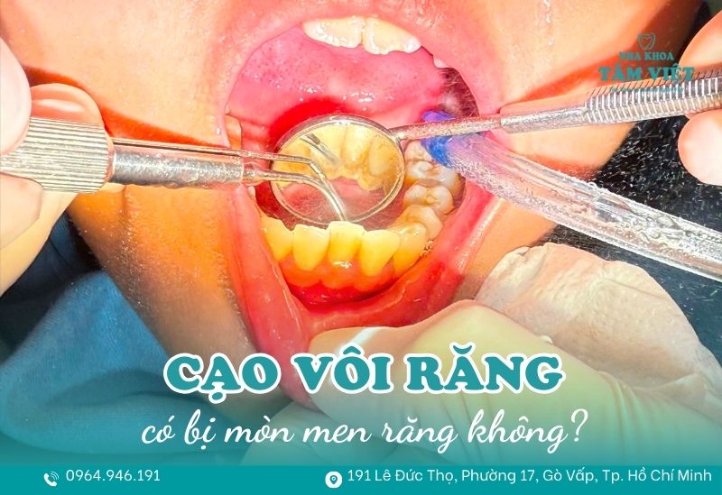 Cạo vôi răng có mòn răng không? Giải thích chi tiết 1 Cạo vôi răng có mòn răng không