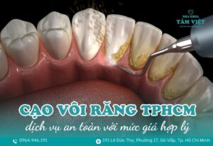 cạo vôi răng ở đâu tốt TPHCM
