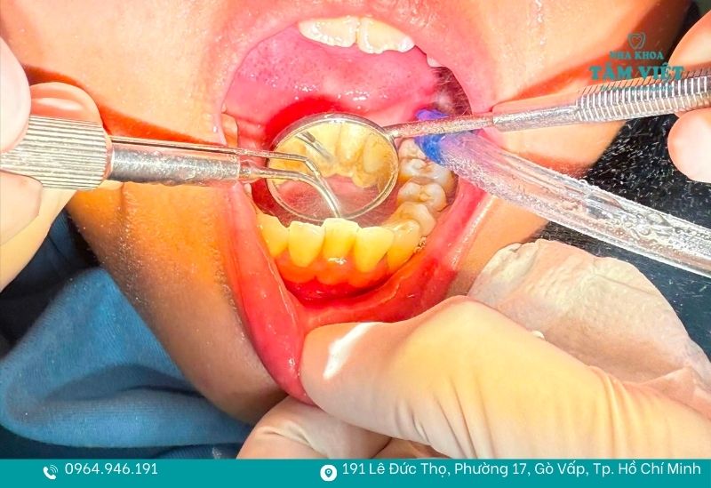 Cạo vôi răng ở đâu tốt TPHCM an toàn, giá hợp lý? 2 Loại bỏ hoàn toàn mảng bám, giúp răng sáng mịn hơn