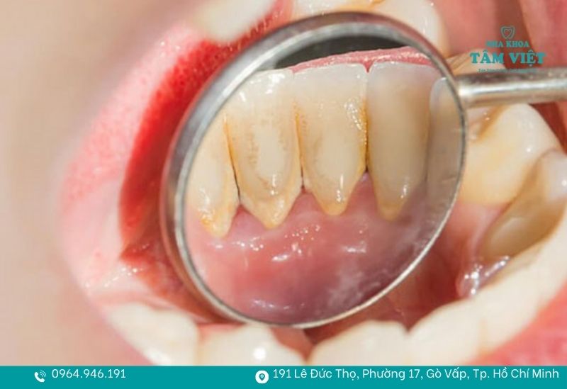 Cạo vôi răng ở đâu tốt TPHCM an toàn, giá hợp lý? 6 Cạo vôi răng tại Nha khoa Tâm Việt