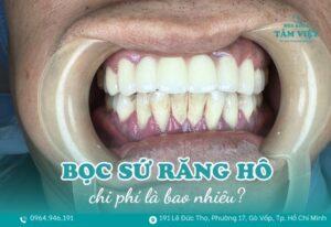 chi phí bọc răng sứ cho răng hô
