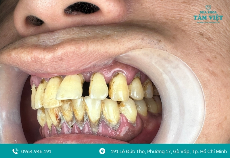 Chi phí lấy cao răng bao nhiêu? Cập nhật giá mới nhất 2 Mức độ cao răng ảnh hưởng đến chi phí lấy cao răng