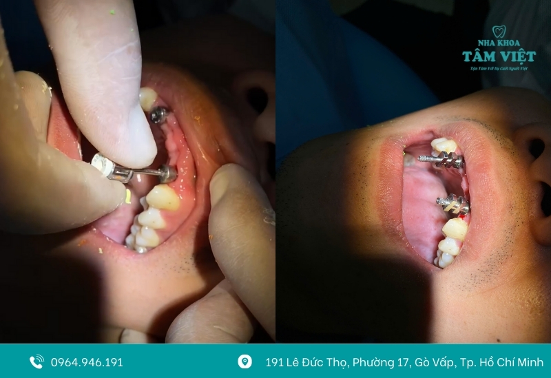 Cấy ghép implant an toàn, chuẩn Y khoa