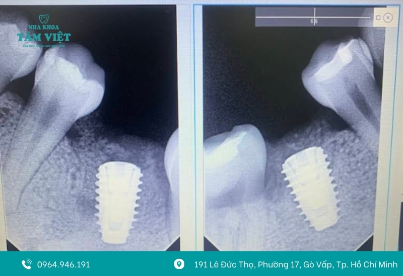 Trụ Implant chính hãng từ các thương hiệu uy tín