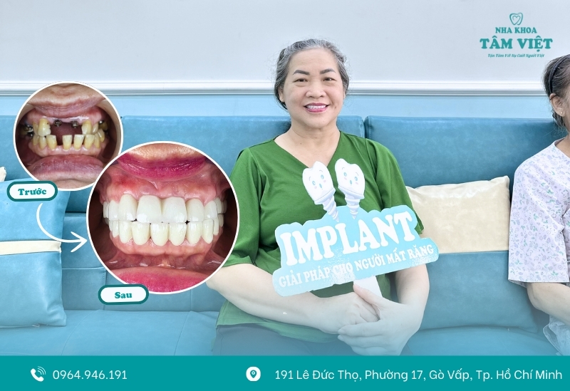Khách hàng cấy ghép implant tại Tâm Việt