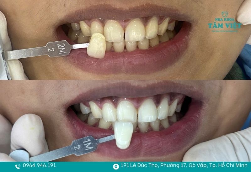 Hiệu quả tẩy trắng chỉ sau 45-60 phút