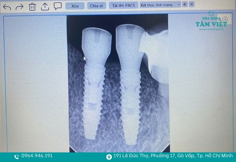Khám phá lợi ích cấy ghép implant và những giá trị bền vững 3 Răng implant tồn tại độc lập tại vị trí mất răng