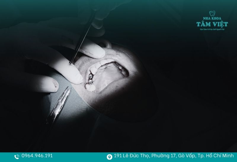 Khám phá lợi ích cấy ghép implant và những giá trị bền vững 4 Cấy ghép implant bảo tồn khuôn mặt