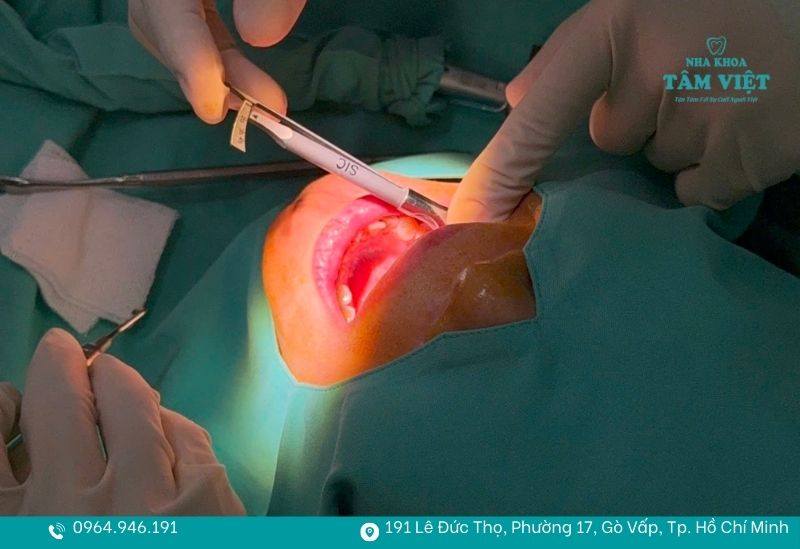 Khám phá lợi ích cấy ghép implant và những giá trị bền vững 6 Bước đặt trụ implant