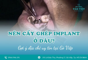 Nên cấy ghép implant ở đâu uy tín tại Gò Vấp?