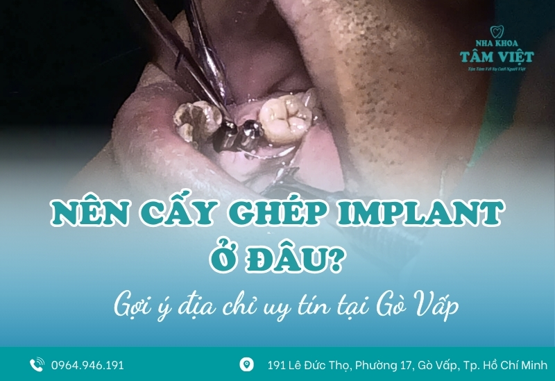 Nên cấy ghép implant ở đâu uy tín tại Gò Vấp?