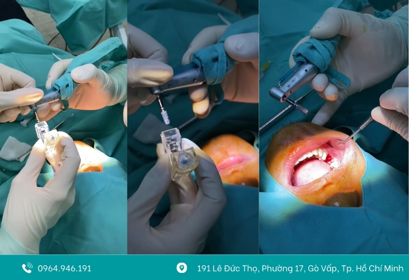 Quy trình cấy implant vô trùng khép kín