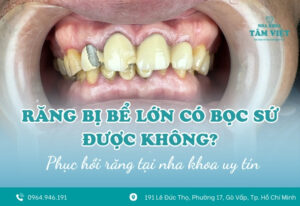 Răng bị bể lớn có bọc sứ được không?