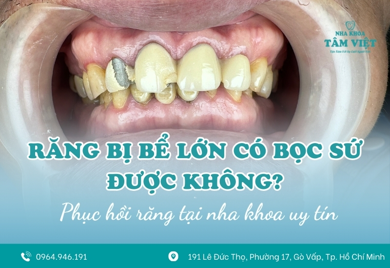 Răng bị bể lớn có bọc sứ được không? 1 Răng bị bể lớn có bọc sứ được không?