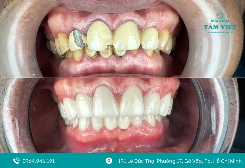 Răng bị bể lớn có bọc sứ được không?