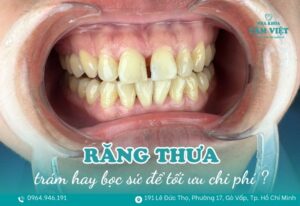 răng thưa nên trám hay bọc sứ
