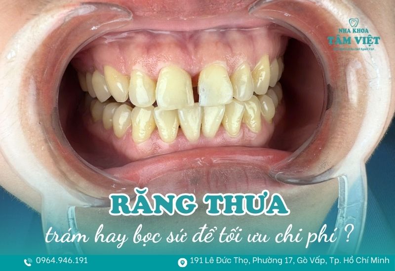 Răng thưa nên trám hay bọc sứ để tối ưu chi phí điều trị? 1 răng thưa nên trám hay bọc sứ