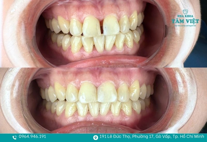 Răng thưa nên trám hay bọc sứ để tối ưu chi phí điều trị? 3 Trám răng thưa tiết kiệm chi phí