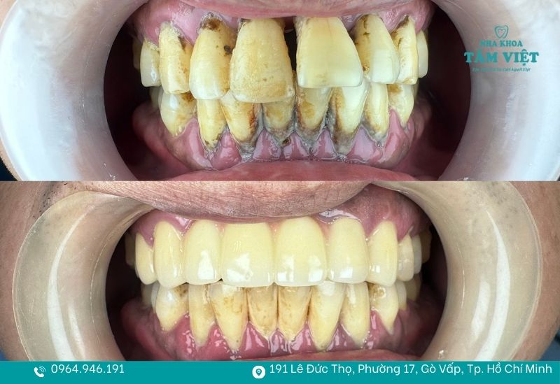 Răng thưa nên trám hay bọc sứ để tối ưu chi phí điều trị? 4 Bọc răng sứ cho răng thưa