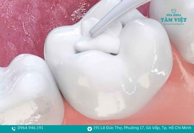 Răng trám bị đau khi nhai do đâu? Có cần điều trị lại không? 2 Miếng trám được tạo hình quá dày