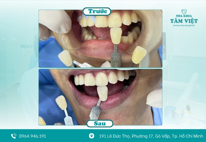 Tẩy trắng răng cho hiệu quả rõ rệt