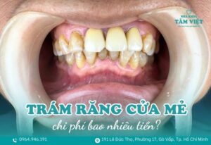 trám răng cửa mẻ bao nhiêu tiền